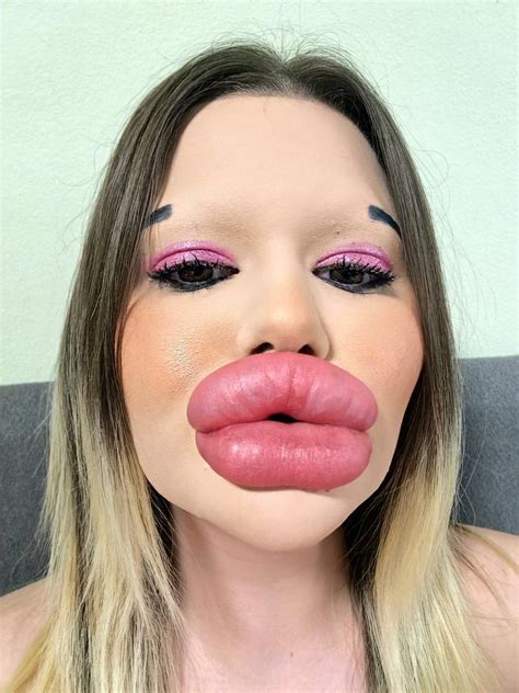Im A Plastic Surgery Fanatic With Worlds Biggest Lips But Now Im