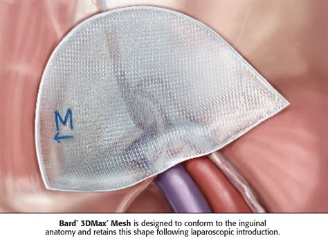 3dmax™ Mesh Clinically Proven For Inguinal Hernia Repair Bd
