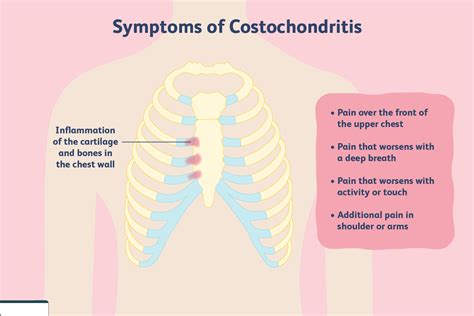 Costochondritis Cuasesymptoms Diagnosis Treatment