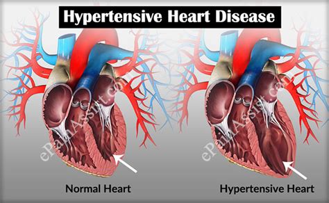 Dr Naval Parikh Hypertension Symptoms Causes And Treatments