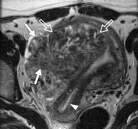 Uterine Smooth Muscle Tumors With Unusual Growth Patterns Imaging With