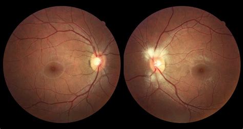 Digital Retinal Screening At Morrice Evans Opticians