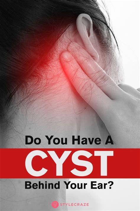 Pin On Cyst