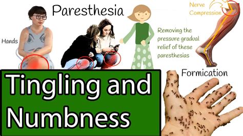 Numbness And Tingling Causes Of Paresthesia Youtube
