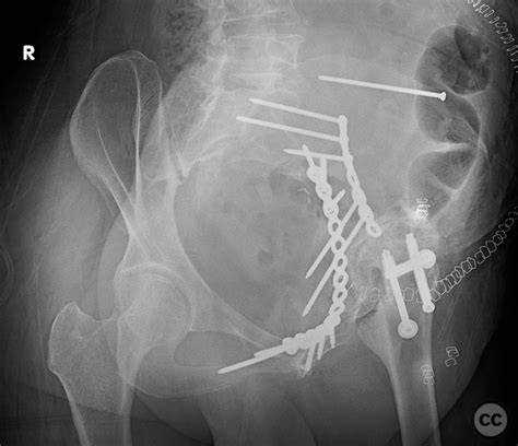 Associated Both Column Acetabular Fracture And A Femoral Neck Fracture