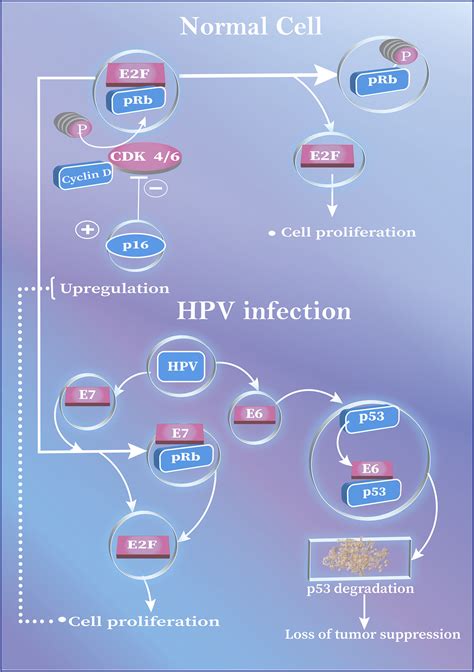 Hpv Driven Anal Neoplasia Review And Recent Developments Pathology