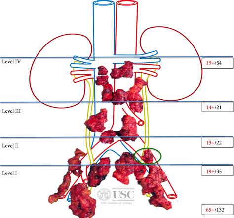 Robotic Salvage Retroperitoneal And Pelvic Lymph Node Dissection For