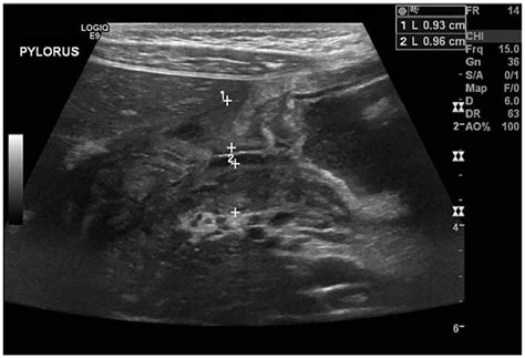 Gastric Outlet Obstruction Secondary To Pyloric Thickening In An
