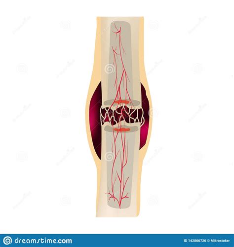 2 Stage Of Healing Bone Fracture Formation Of Callus The Bone Fracture Infographics Vector