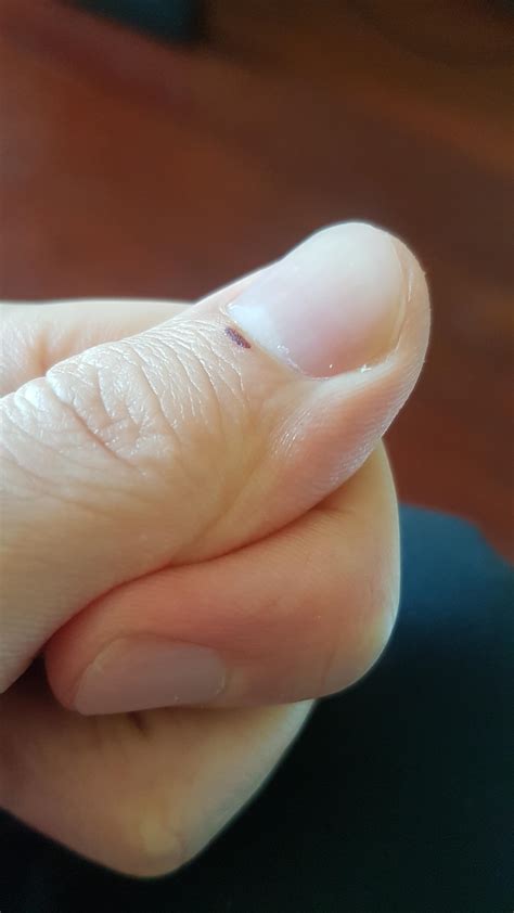 This Black Spot Appeared In The Skin Under My Nail Its Very Peculiar