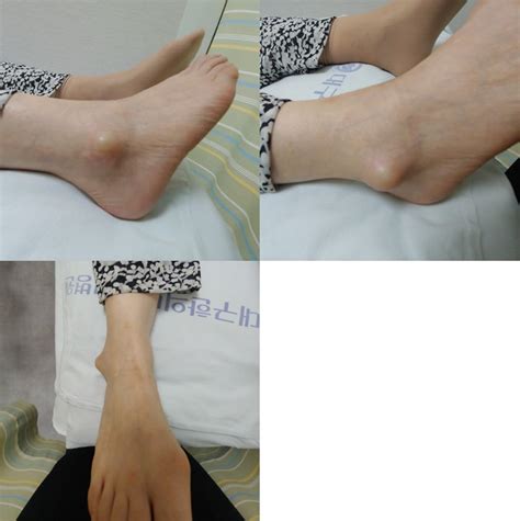 Picture Of The Lateral Malleolus Of The Right Foot On Visit 1