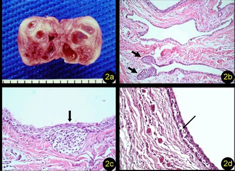 Clinical And Histologic Features Of Botryoid Odontogenic Cyst A Case