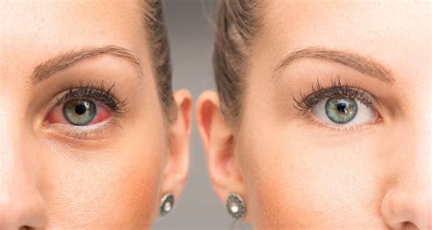 Why Are My Eyes Red And Bloodshot Causes And Treatment Ocuwellness