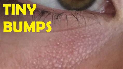How To Get Rid Of Tiny Bumps Around Eyes Easy Youtube