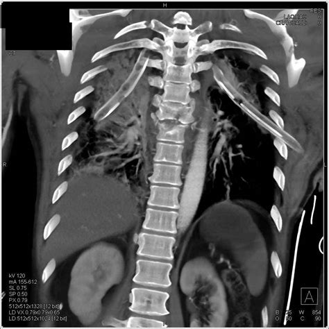 Thoracic Spine Fractures With Posterior Mediastinal Hematoma Sp Trauma