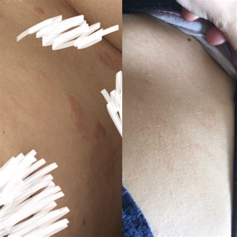 My Pityriasis Rosea Story Picture Of Healing Included Pityriasis