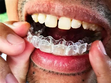 Man Is Wearing Invisalign Braces Orthodontic Silicone Trainer Stock