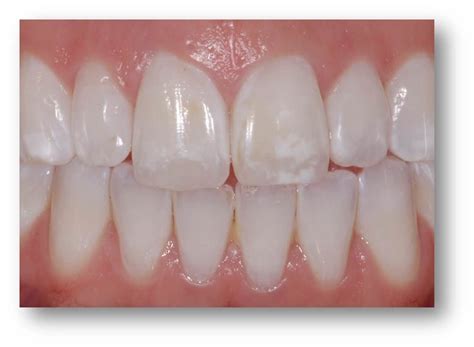 White Spots On The Teeth Health With Nature
