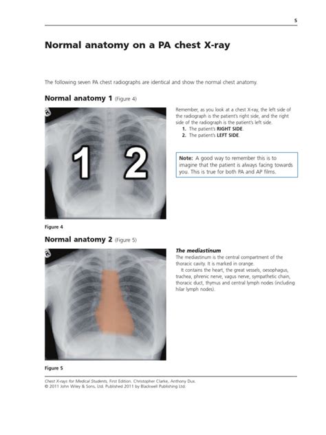 Normal Anatomy On A Pa Chest X Ray Lung Thorax