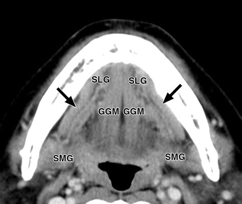 Imaging Of The Mylohyoid Muscle Separation Of Submandibular And