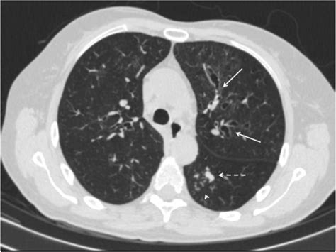 Should We Consider Paranasal And Chest Computed Tomography In Severe