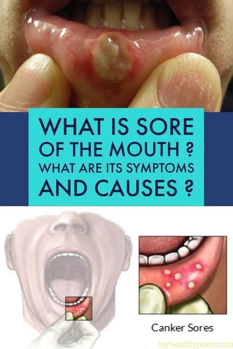 what is sore of the mouth what are its symptoms and causes with images oral sores mouth