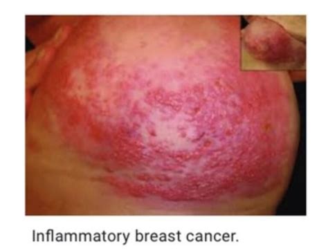 What Does Inflammatory Breast Cancer Rash Look Like Public Health