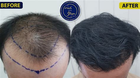 Hair Transplant In Mumbai Hair Transplant Results Hairloss