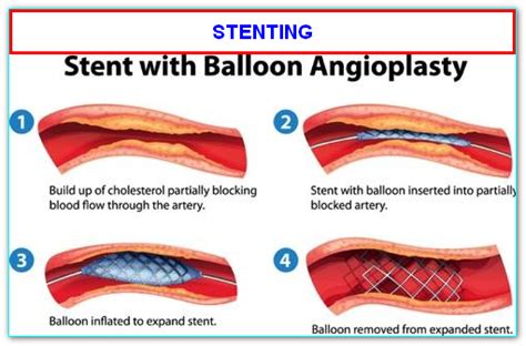 Facts About Stent Surgery To The Heart Angioplasty Or Ptca Or Pci