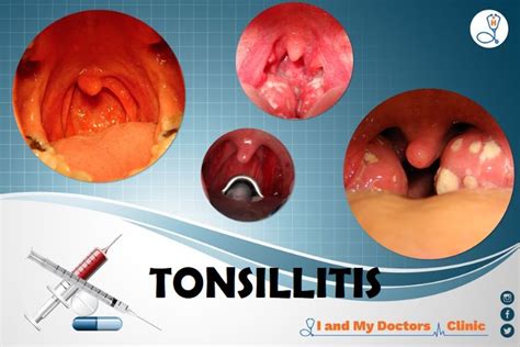 Tonsils And Lymph Nodes