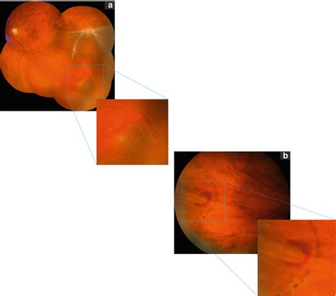 Peripheral Retinal Degenerations As A Risk Factor For Rhegmatogenous
