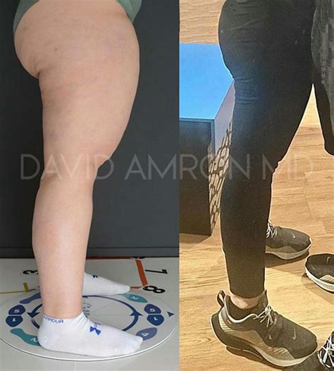 Patient 45225422 Lipedema Before And After Photos David Amron Md