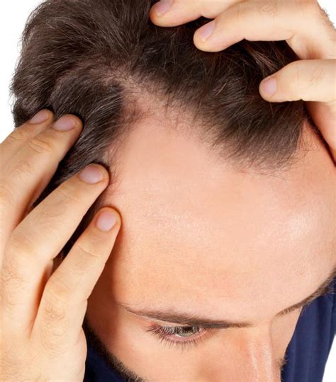 What Is Burning Scalp Syndrome With Pictures