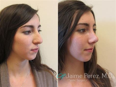 2 Weeks After Nose Job Nose Job Rhinoplasty Before And After Gallery