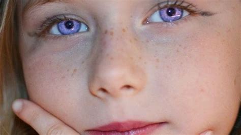 Alexandria Syndrome The Rare Condition Of Purple Eyes