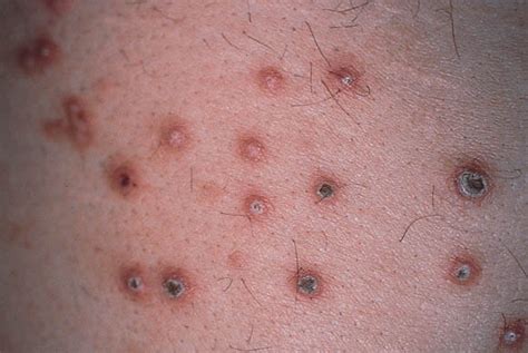 Abnormalities result from a systemic disease (secondary renal diseases). Cutaneous manifestations of end-stage renal disease ...