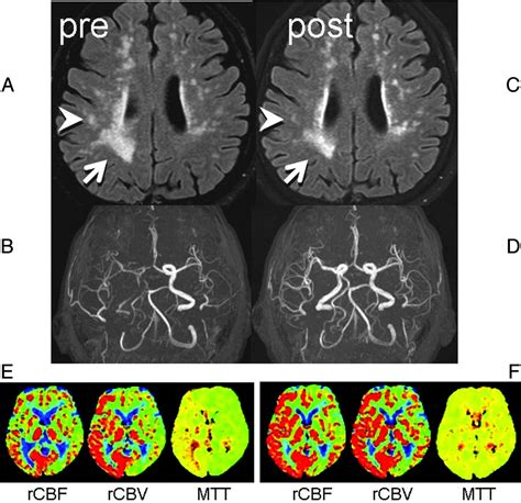 Cerebral White Matter Lesions May Be Partially Reversible In Patients