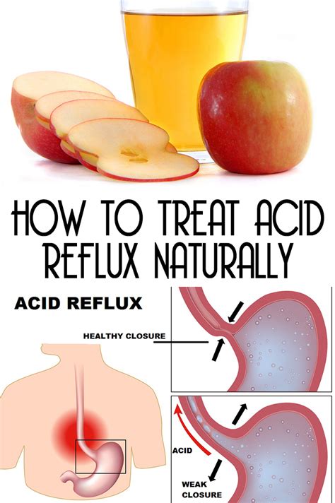 How To Treat Acid Reflux Naturally With A Single