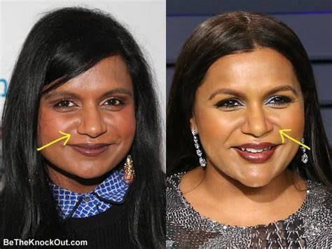 Mindy Kaling Plastic Surgery Comparison Photos