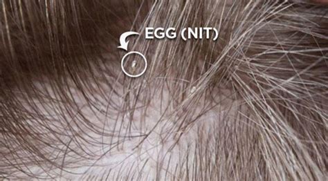What Are Nits And What Do They Look Like The Lice Removal Clinic