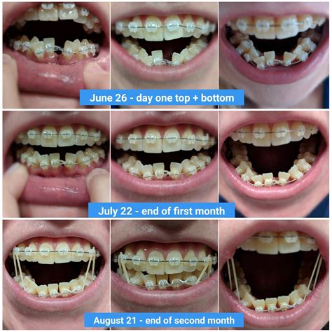 Lower Front Incisor Extraction 2 Month Progress Gap Is Almost Closed
