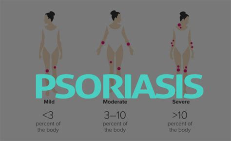 Psoriasis What Are The Symptoms Diagnosis And Treatment