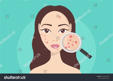 Acne Skin Problems Stages Acne Woman Stock Vector Royalty Free