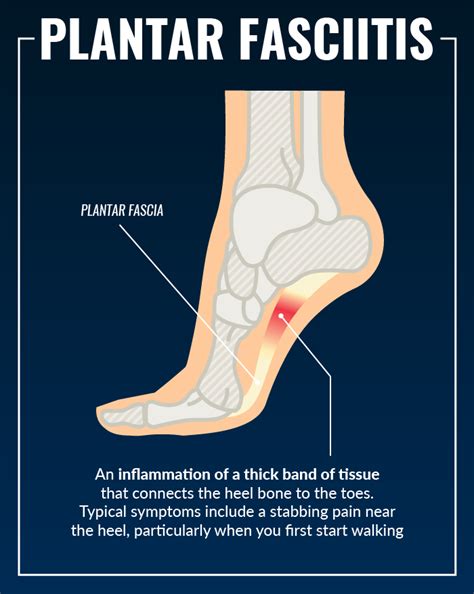 How To Self Treat Plantar Fasciitis The Physical Therapy Advisor