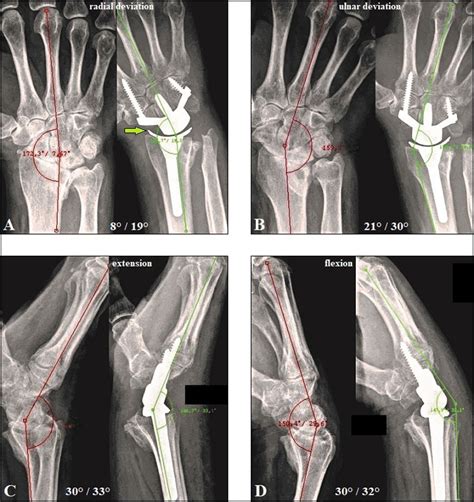 Functional Outcomes After Salvage Procedures For Wrist Trauma And Arthritis Four Corner Fusion