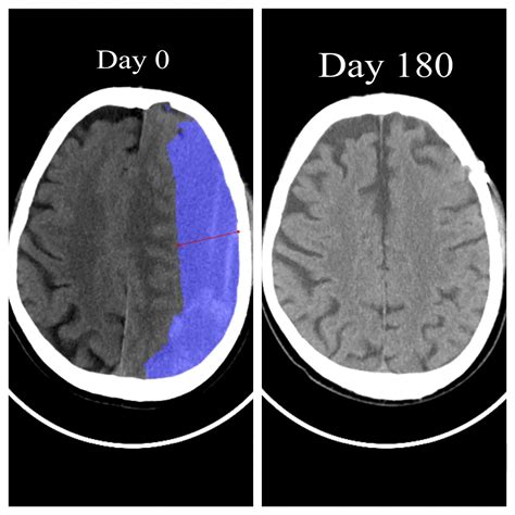 Subdural Hematoma Surgery What You Should Know