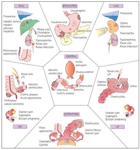 Acute Abdomen Liberal Dictionary