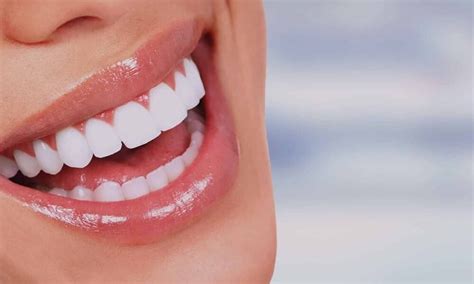 Lentes De Contato Dental Conheça O Procedimento Que Tem Transformado O Sorriso Dos Famosos