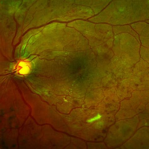 Wet Exudative Or Neovascular Age Related Macular Degeneration With