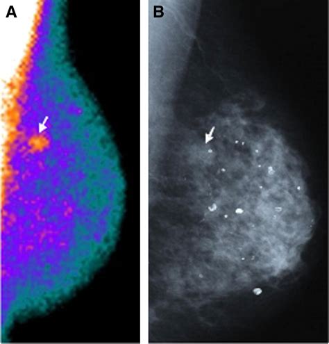 Breast Scintigraphy With Breast Specific γ Camera In The Detection Of